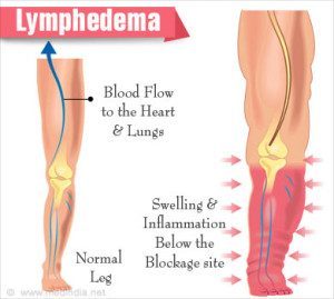 lymphedema